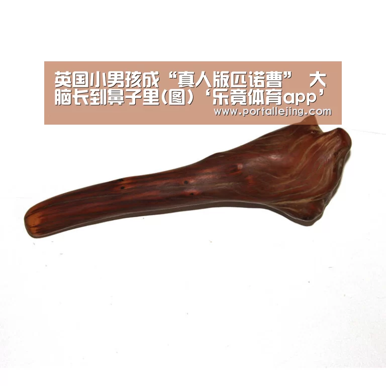 英国小男孩成“真人版匹诺曹” 大脑长到鼻子里(图)‘乐竟体育app’(图3) 乐竟体育app